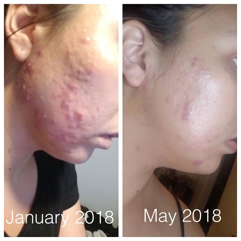 BUTTER ME UP ORGANICS Super Acne Fighter / Organic Acne Treatment / Essential Oils