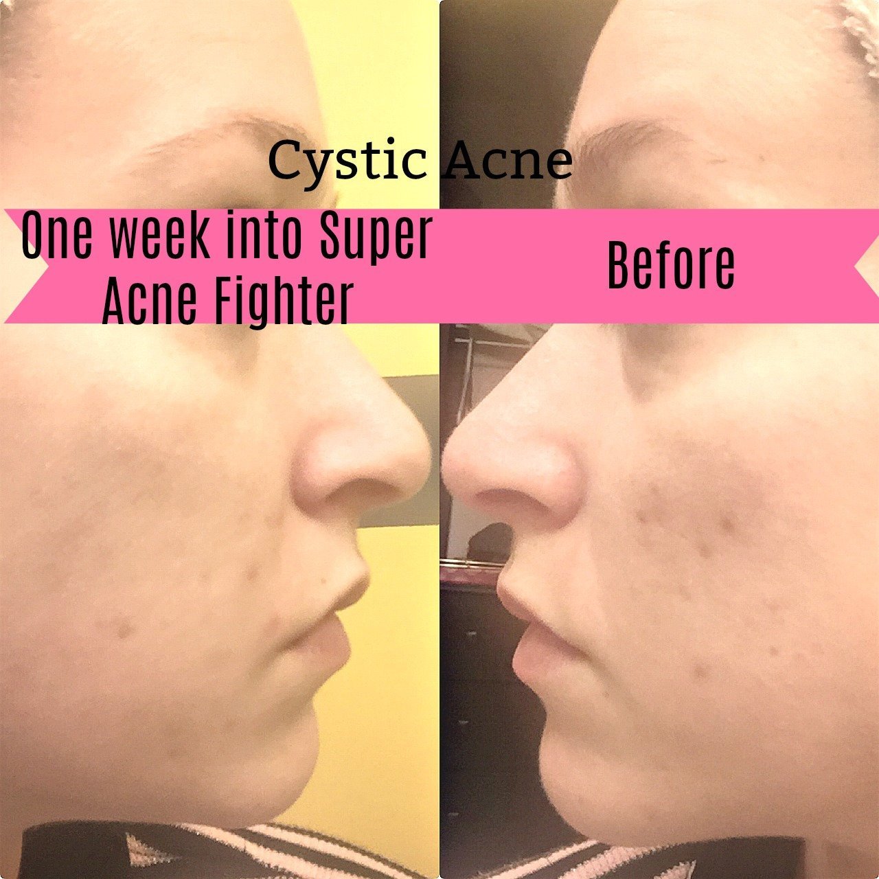 BUTTER ME UP ORGANICS Super Acne Fighter / Organic Acne Treatment / Essential Oils